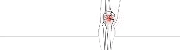 Drawing of Arthritis